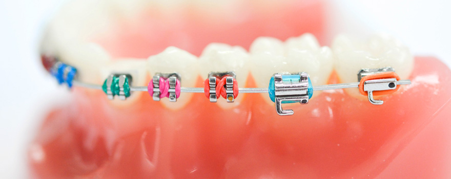 Braces - Metal at The smile mission (Up to 99% Off)