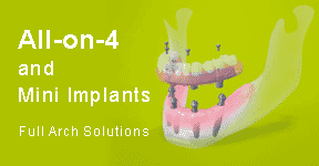 All-on-4 Implants