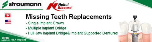 Dental Implant Packages