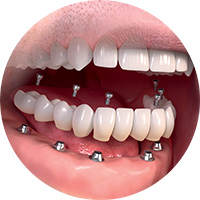 Full Jaw - Implant Bridge