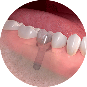 Single Dental Implant