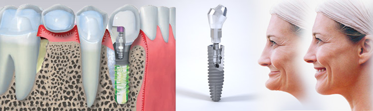 one day implant
