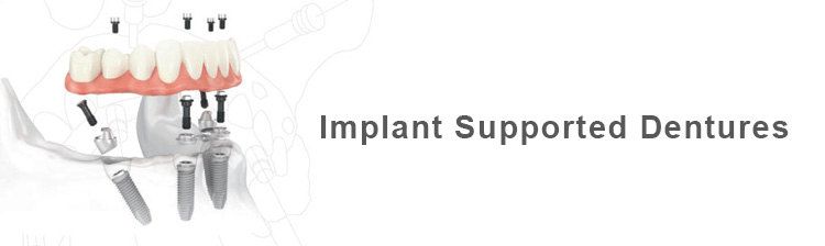 Implant-Supported-Dentures