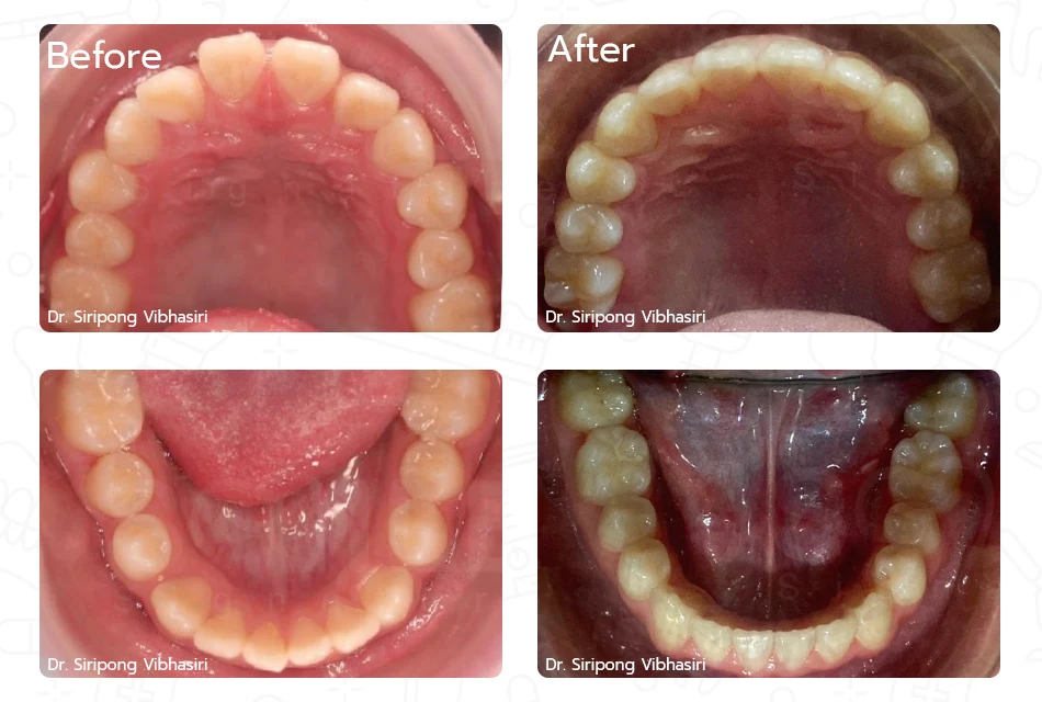 Before/After invisalign clear aligners