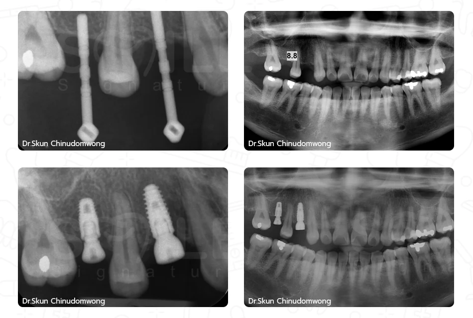 SIC Dental Implants Dr.Skun at Smile Signature