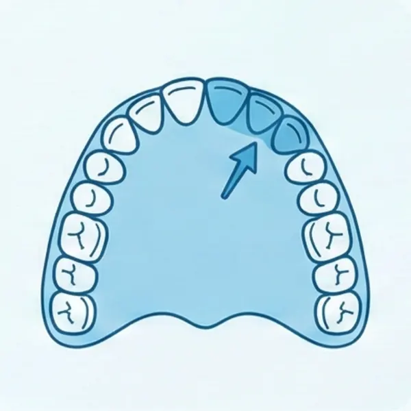 Tooth Surfaces Lingual Palatal