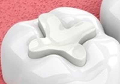 dental fillings Composite Resin
