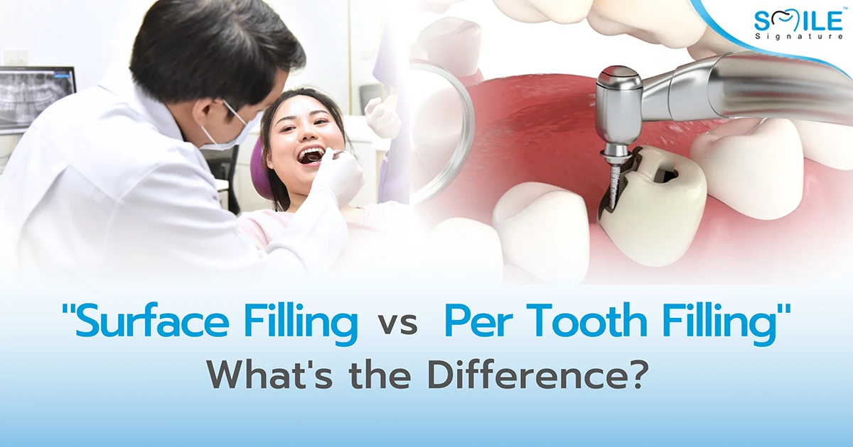 Surface Filling vs Per Tooth Filling