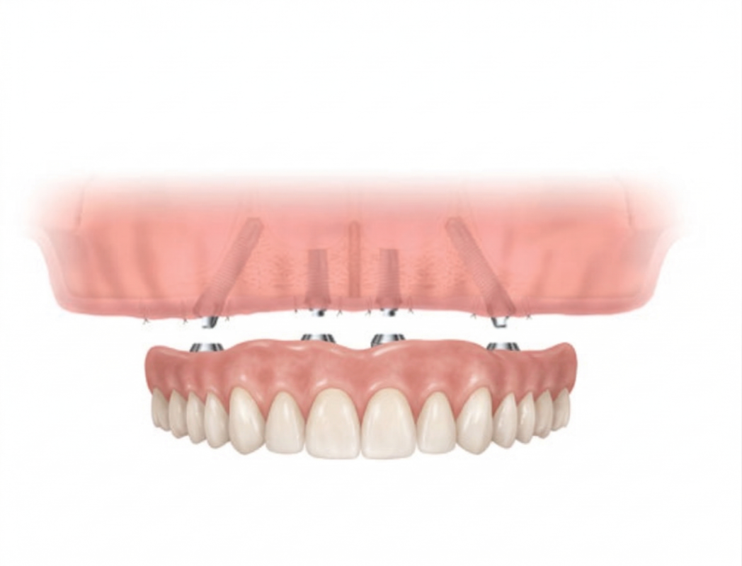 All-on-4 with fixed dentures