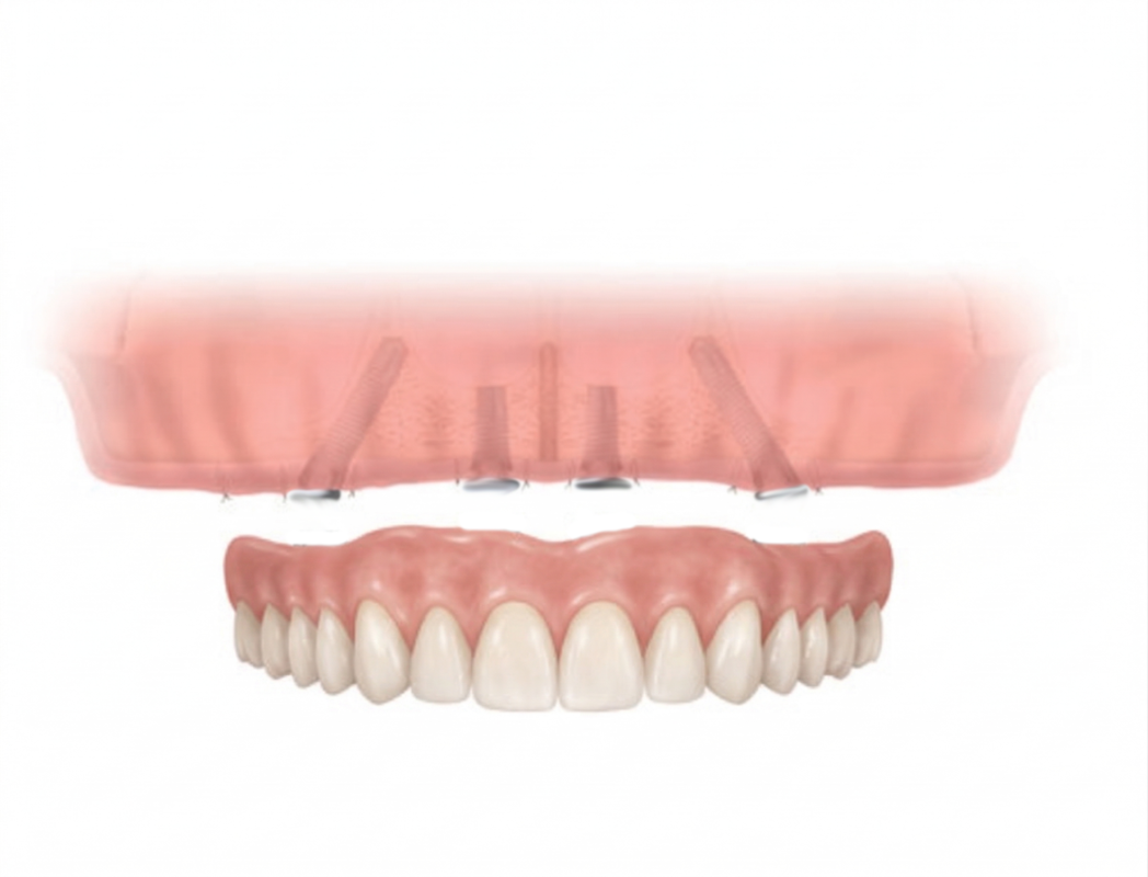 Implant with temporary dentures