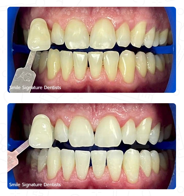 Before-After Teeth Whitening Smile Dentists Sukhumvit
