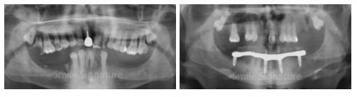 Lower Jaw All-on-4 Implants