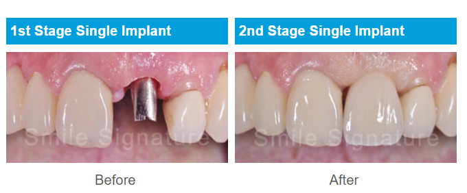 single dental implant