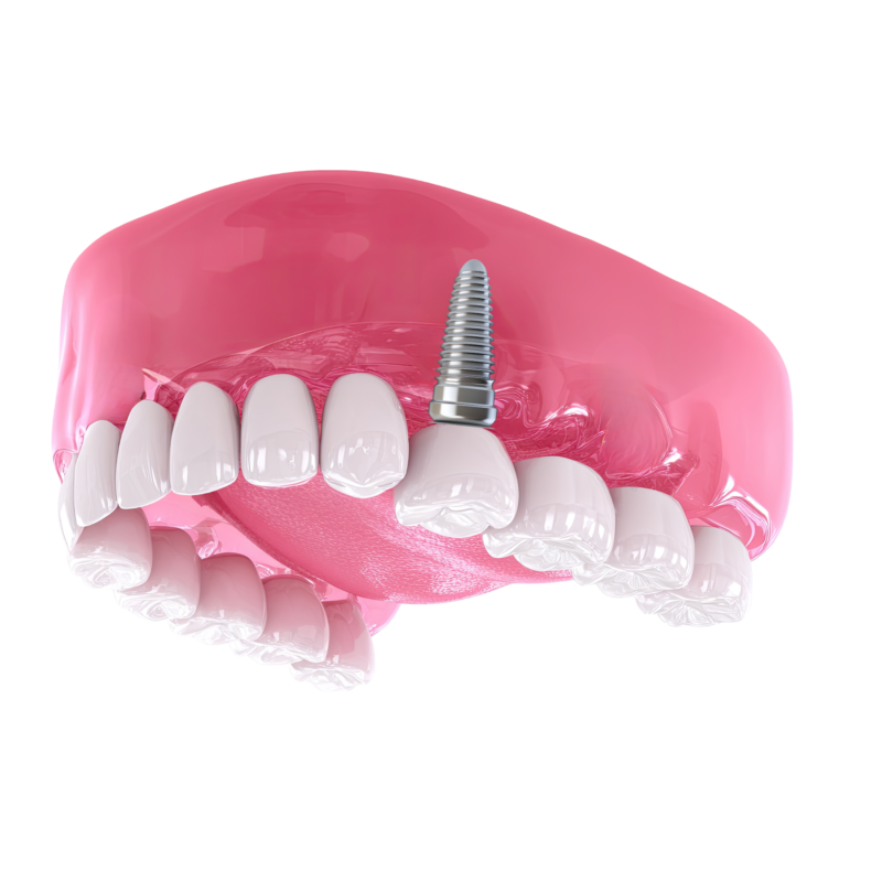 single tooth implant