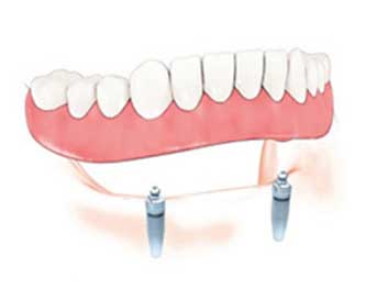 รากฟันเทียมเพื่อรองรับแผงฟันปลอม
