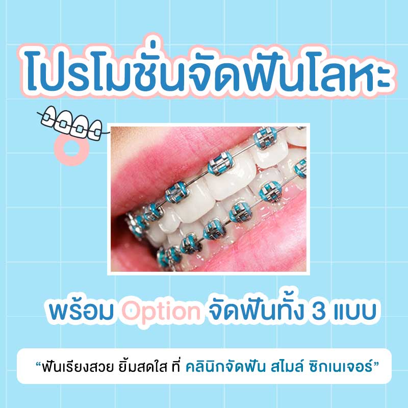 โปรโมชั่นจัดฟันแบบโลหะ
