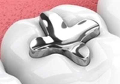 อุดฟันด้วยสีโลหะ (Amalgam)