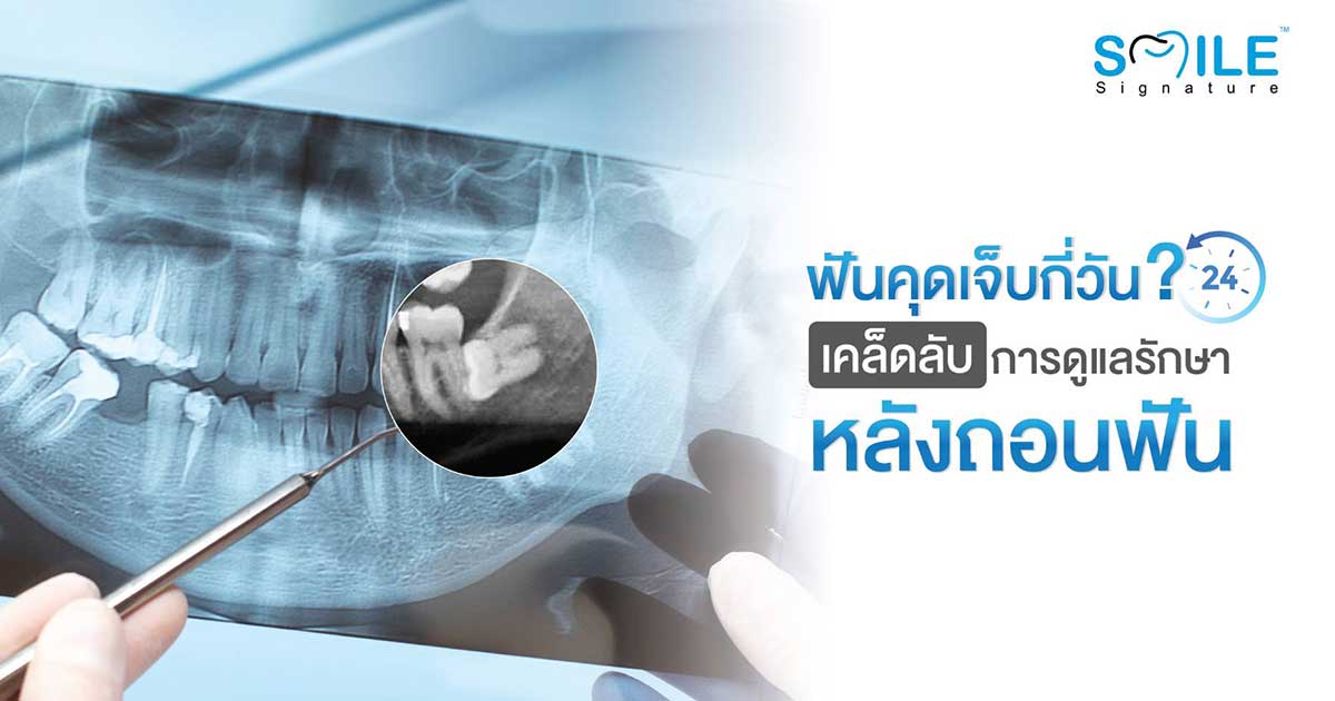 ผ่าฟันคุดเจ็บกี่วัน เคล็ดลับการดูแลรักษาหลังถอนฟัน | สไมล์ ซิกเนเจอร์