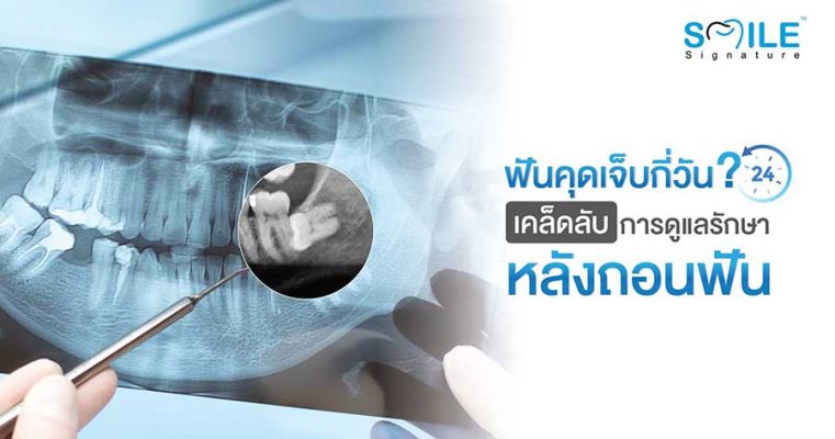 ผ่าฟันคุด