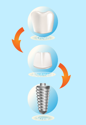 รากฟันเทียมประกอบด้วยอะไรบ้าง