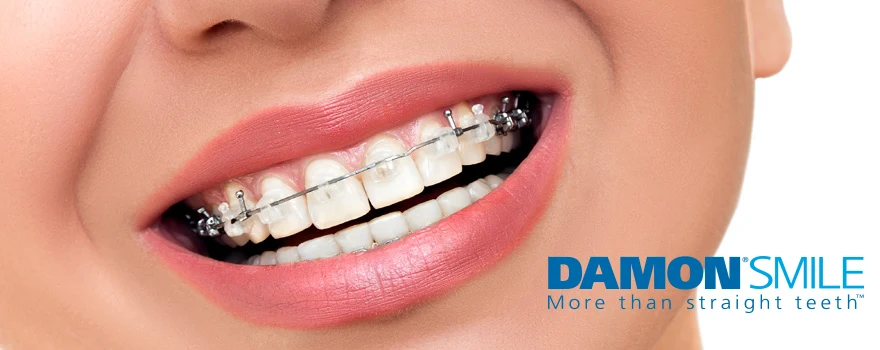 จัดฟันดามอน Damon