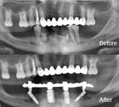 รากเทียมแบบ All On 4