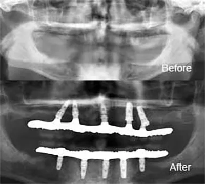 รากเทียมแบบ All On 5