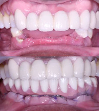 รากเทียม ProArch