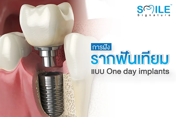 การฝังรากเทียมแบบทันที