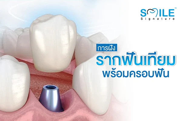 การฝังรากฟันเทียมแบบพร้อมครอบฟันทันที