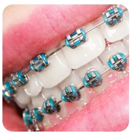 ทำไมต้องจัดฟัน