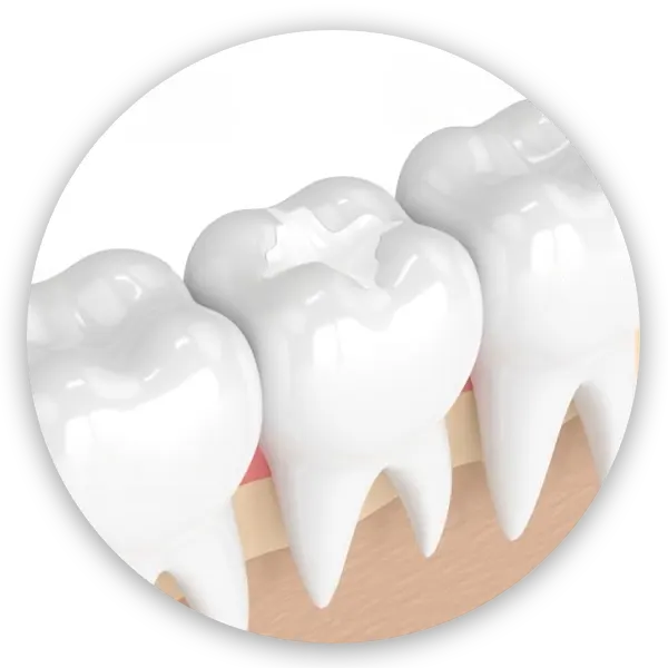 การอุดฟันสีเหมือนฟัน