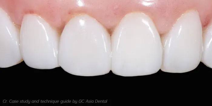 วีเนียร์แบบพรีเมี่ยม