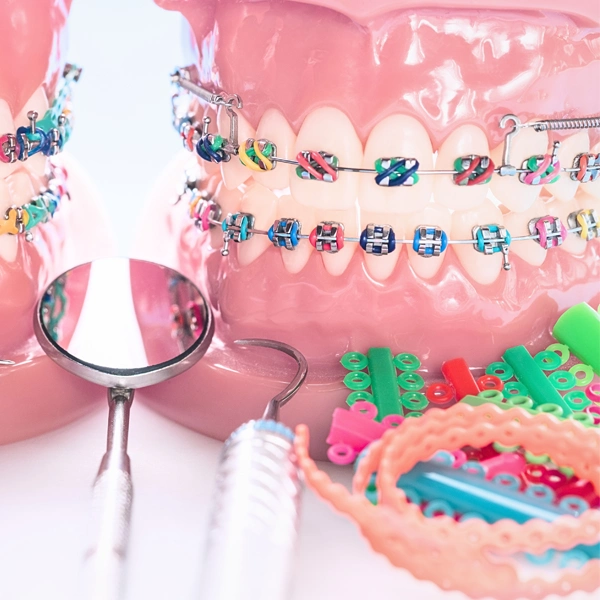 เลือกสียางจัดฟัน