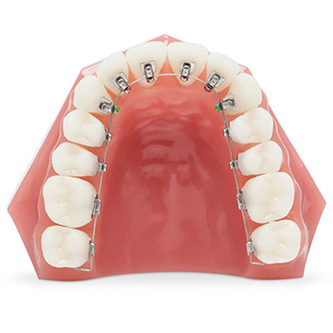 จัดฟันด้านใน