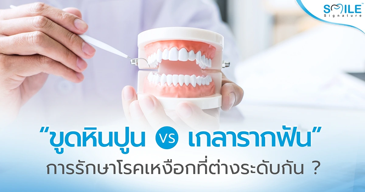 เกลารากฟัน กับ ขูดหินปูน ต่างกันยังไง